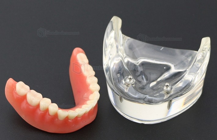 Dental Inferiores Modelo de Implante de sobredentadura 2 Implantes Demostración Modelo 6002 01